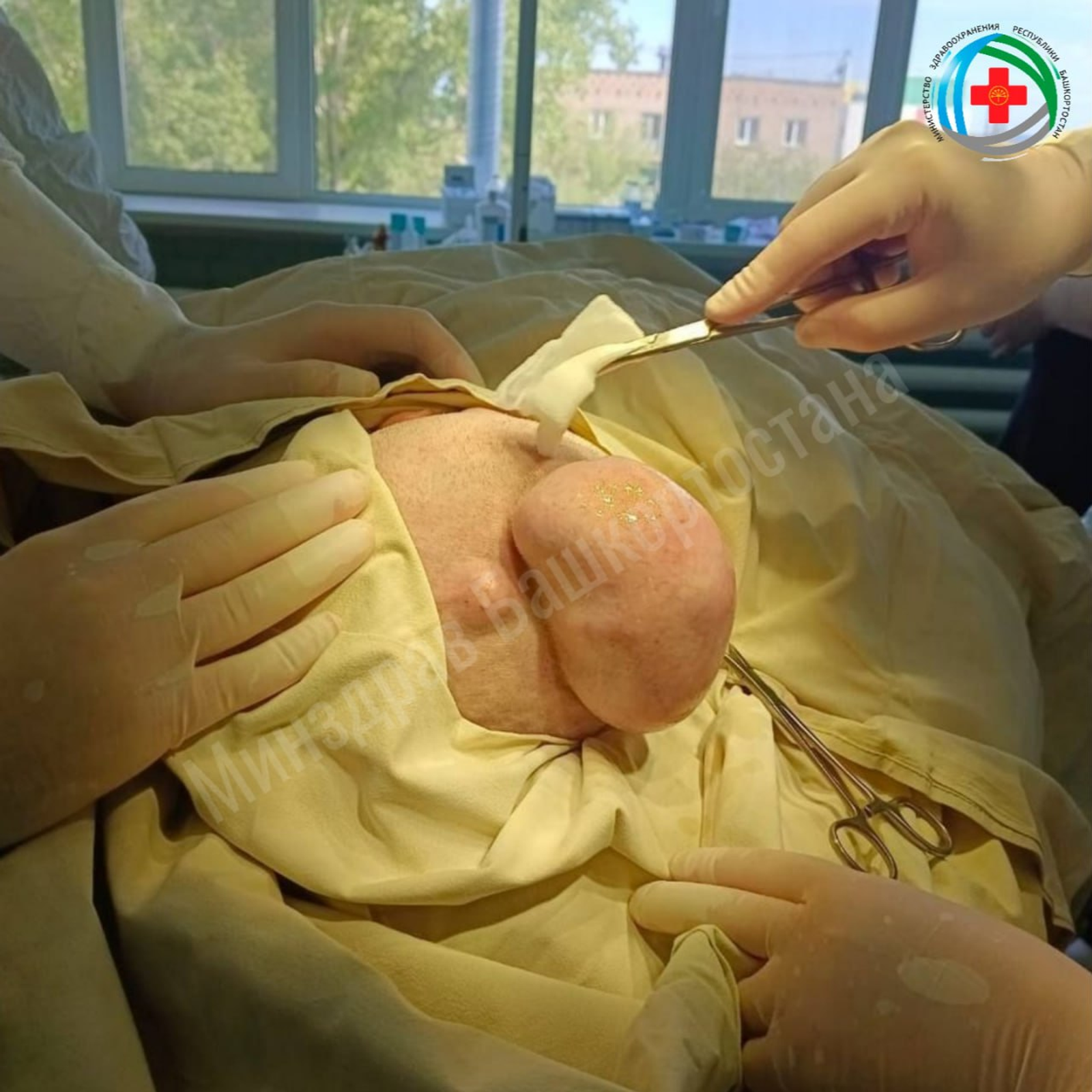 Врачи Бирской больницы удалили огромное новообразование у пожилой женщины